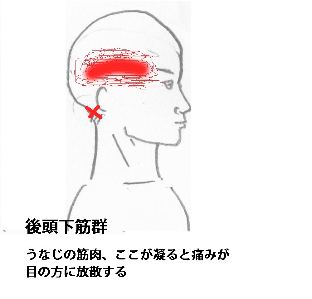 頭痛後頭下筋
